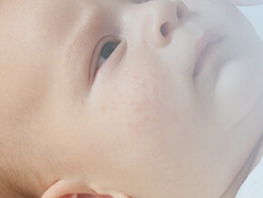 Alergias en niños y bebés